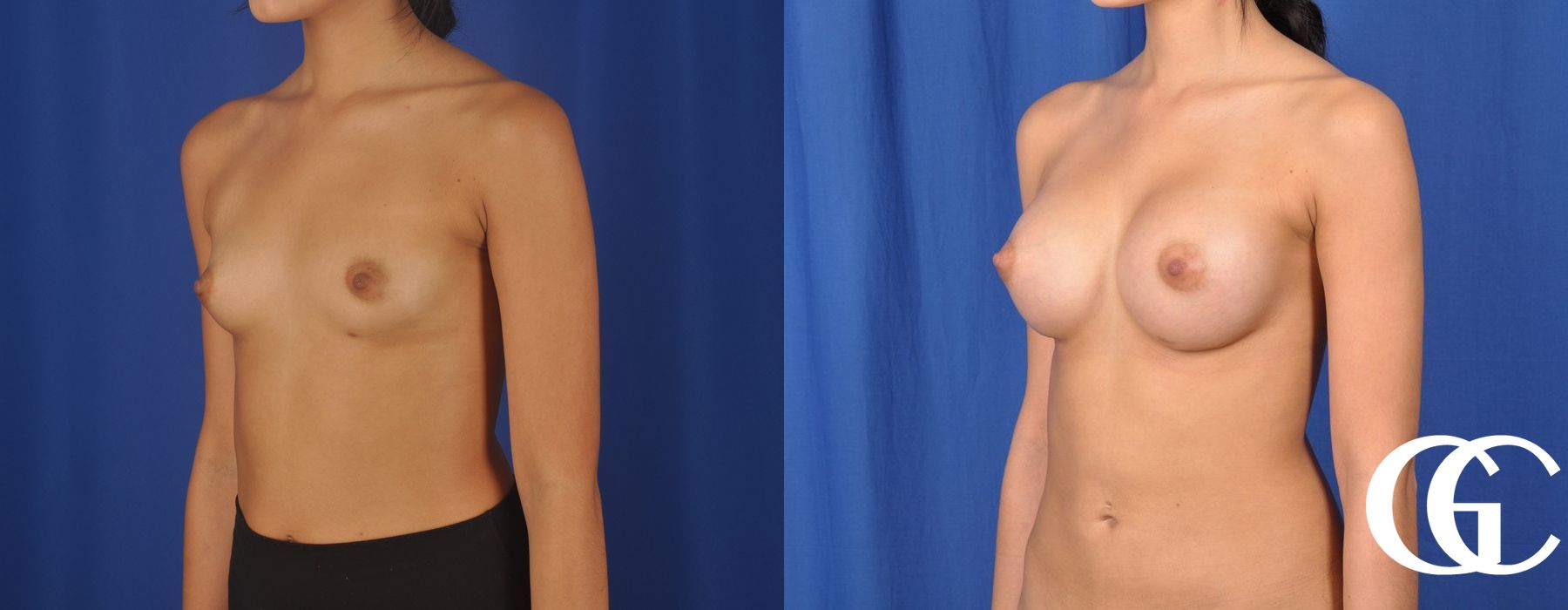 Breast Augmentation - Thumbnail 3
