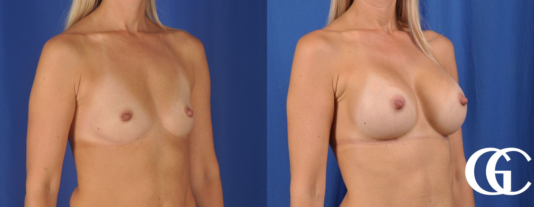 Breast Augmentation - Case 7184