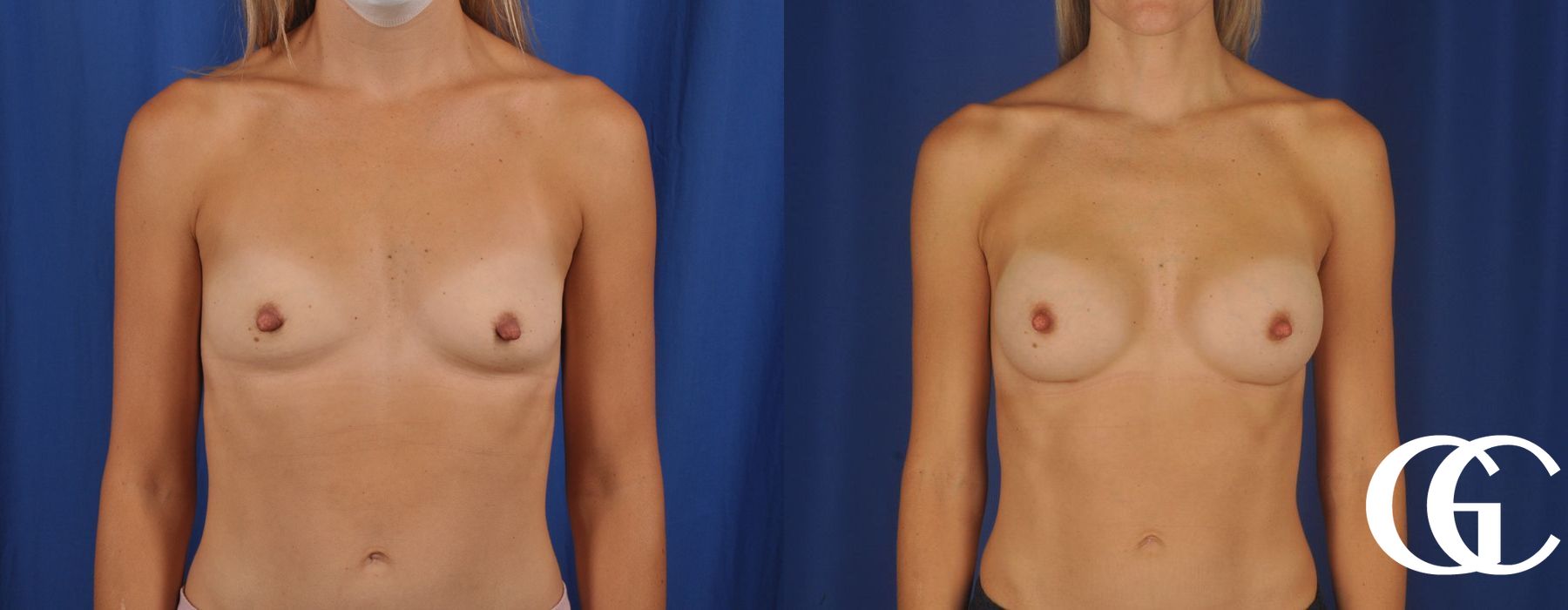 Breast Augmentation - Thumbnail 2