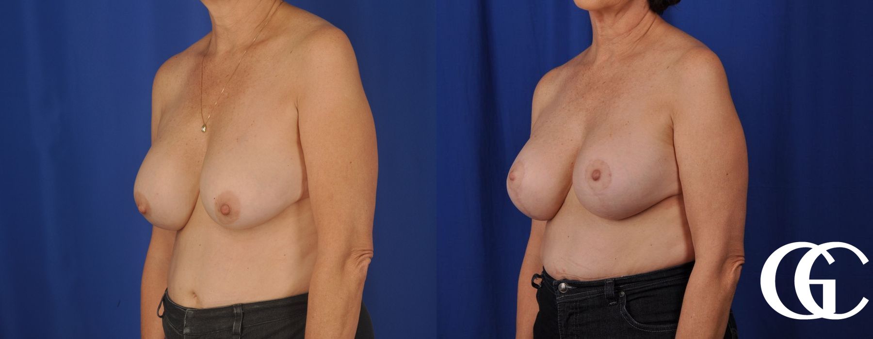 Breast Augmentation - Case 7125