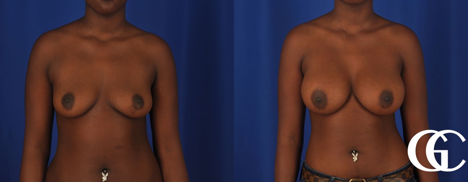 Breast Augmentation - Case 7122
