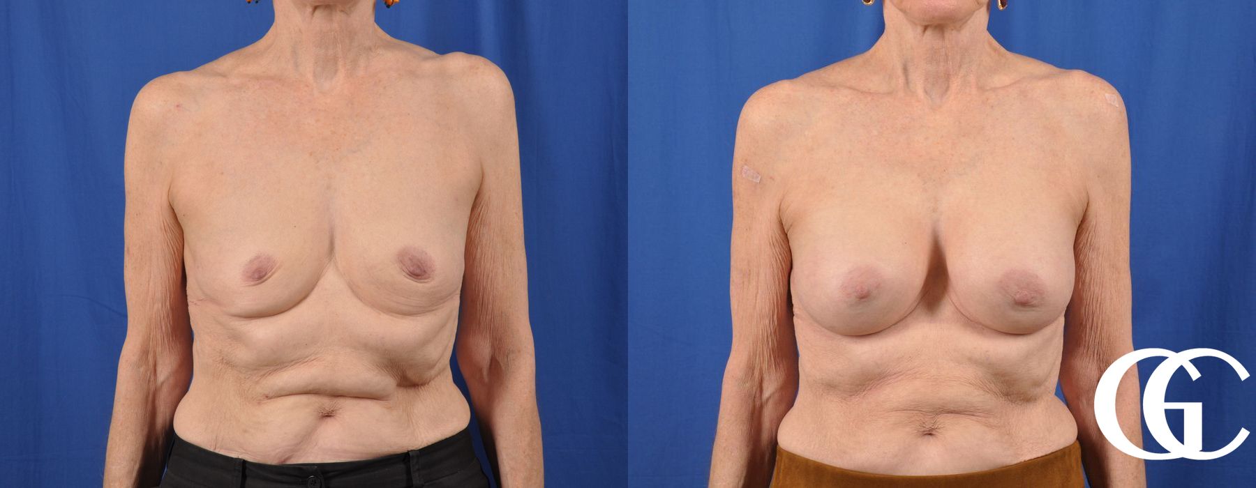 Breast Augmentation - Thumbnail 2