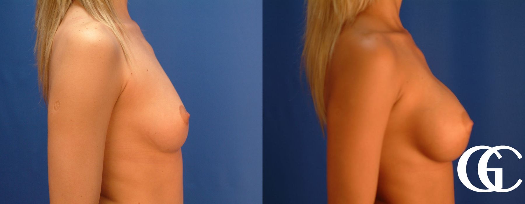 Breast Augmentation - Thumbnail 3
