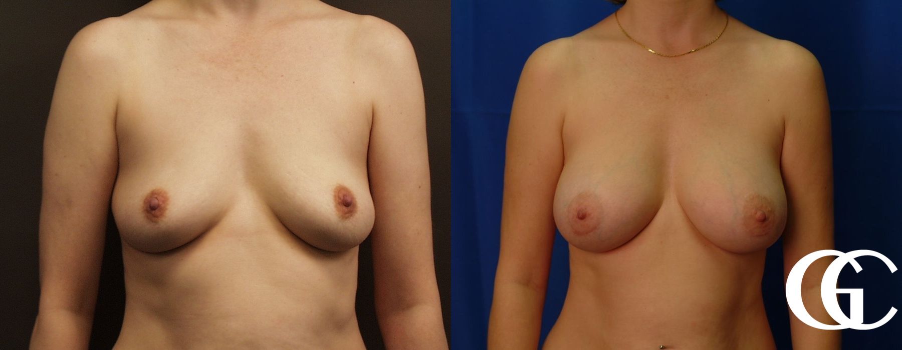 Breast Augmentation - Thumbnail 2
