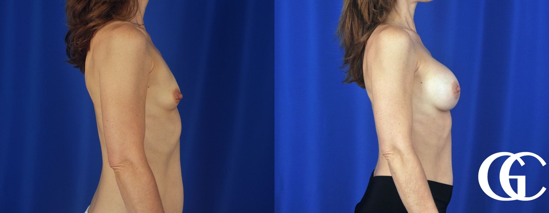 Breast Augmentation - Case 7038
