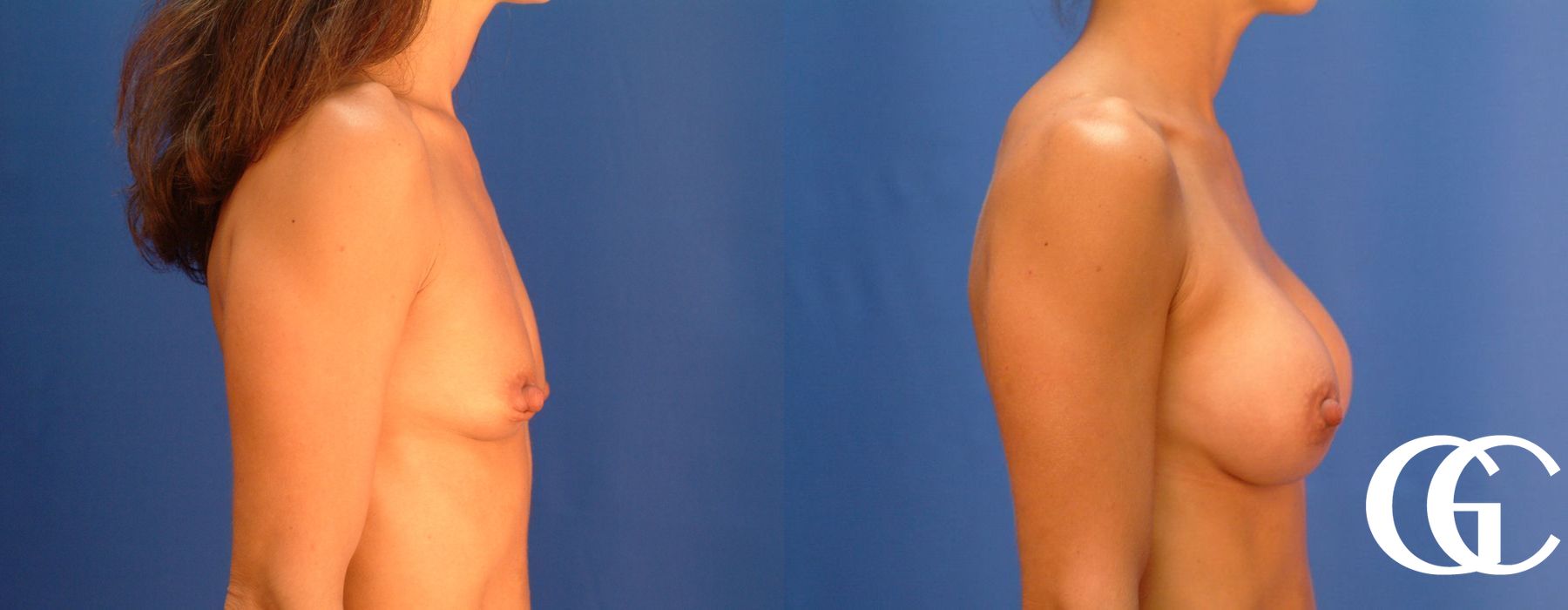 Breast Augmentation - Thumbnail 3