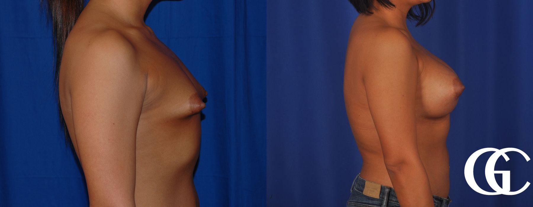 Breast Augmentation - Thumbnail 2