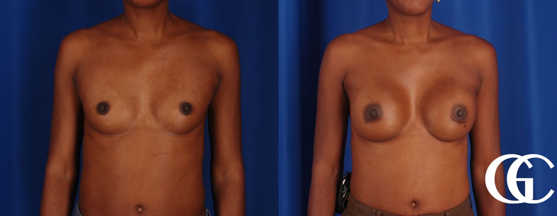 Breast Augmentation - Thumbnail 3