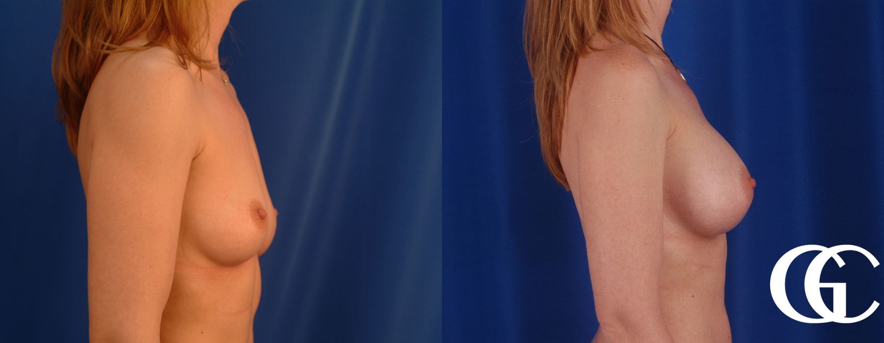 Breast Augmentation - Thumbnail 3