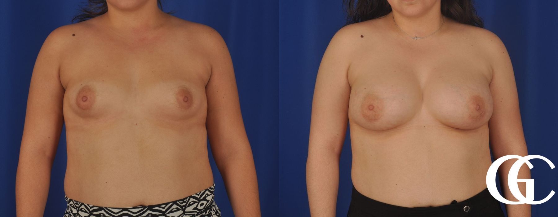 Breast Augmentation - Thumbnail 2