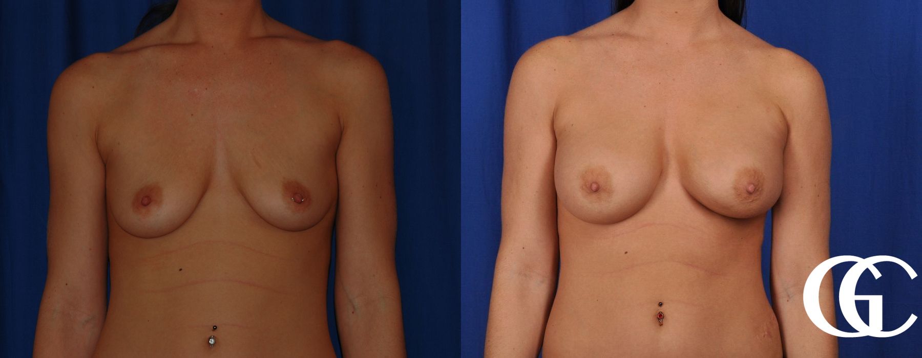 Breast Augmentation - Thumbnail 2
