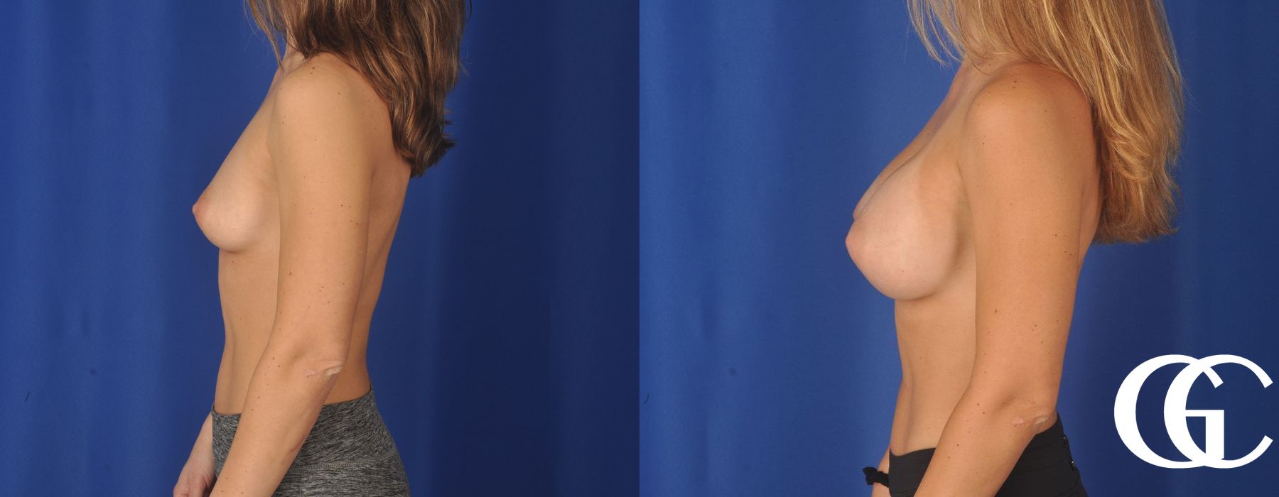 Breast Augmentation - Thumbnail 4