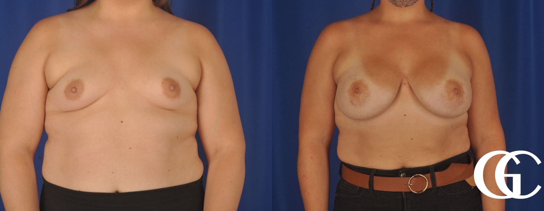 Breast Augmentation - Thumbnail 3