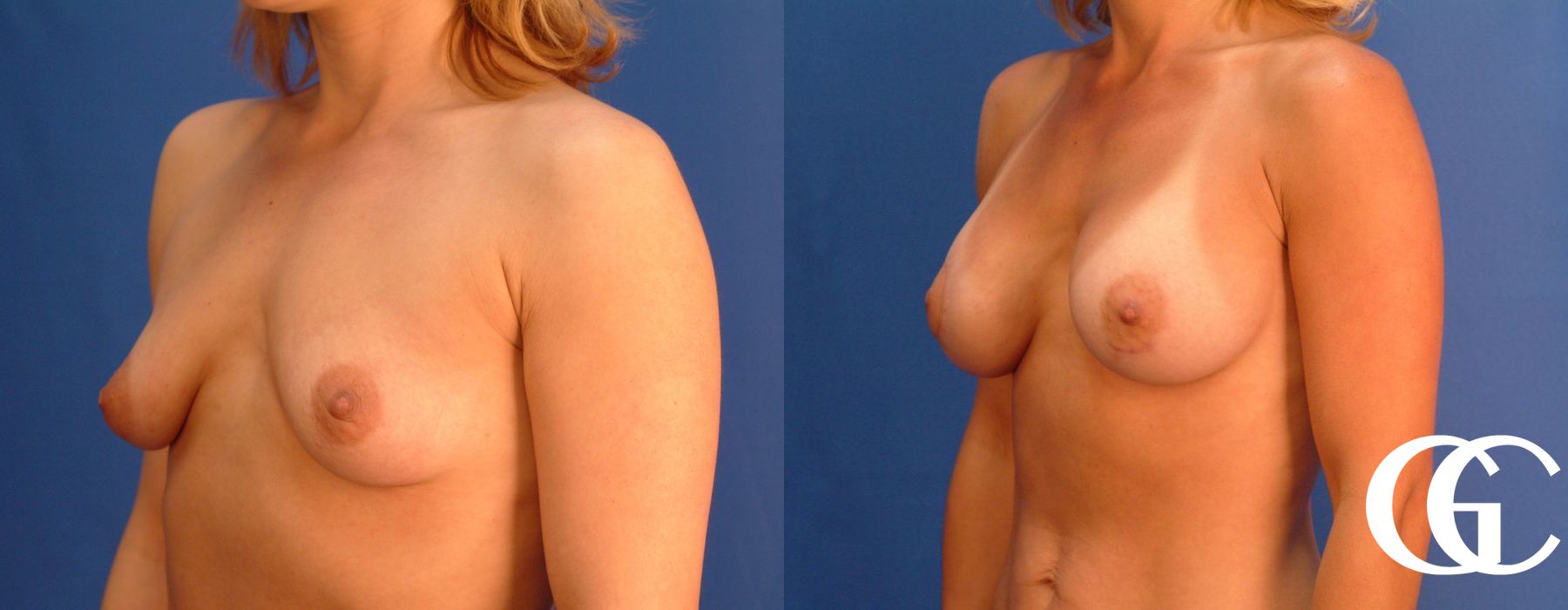 Breast Augmentation - Case 7112