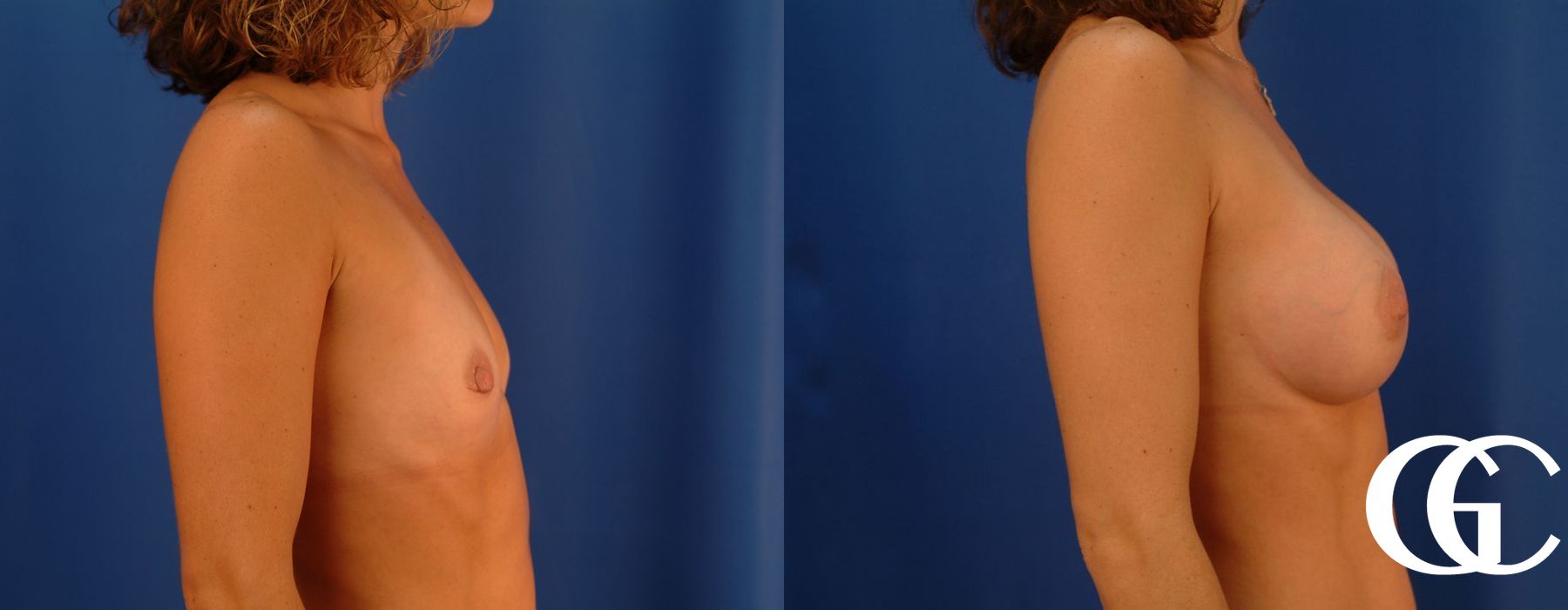 Breast Augmentation - Case 7088