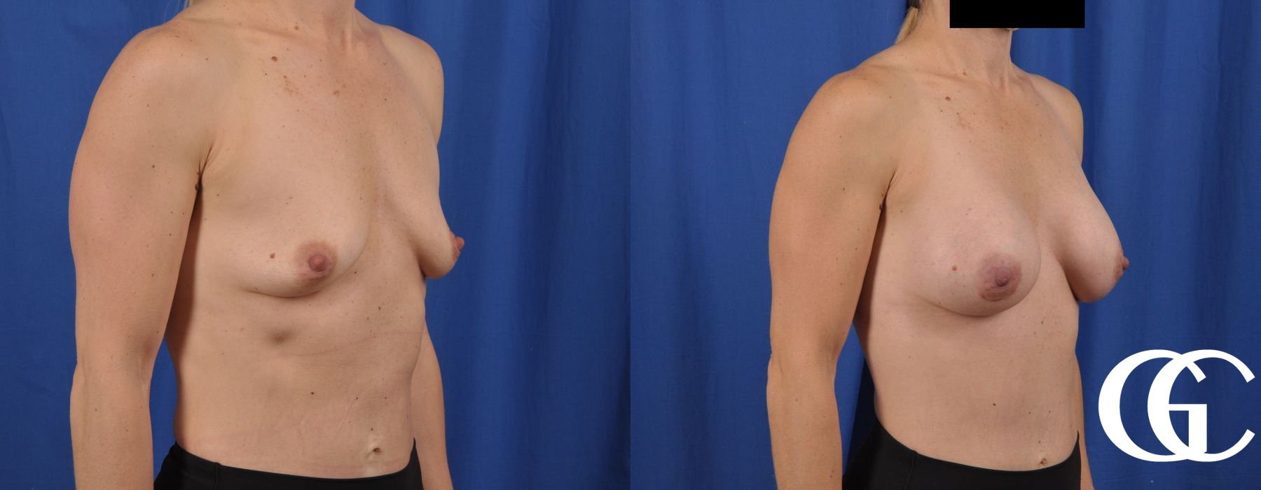 Breast Augmentation - Thumbnail 5