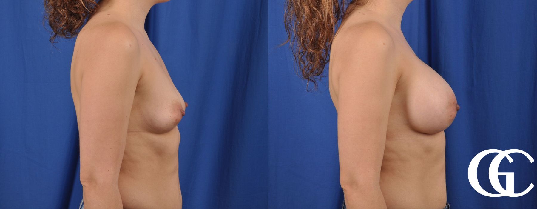 Breast Augmentation - Thumbnail 3