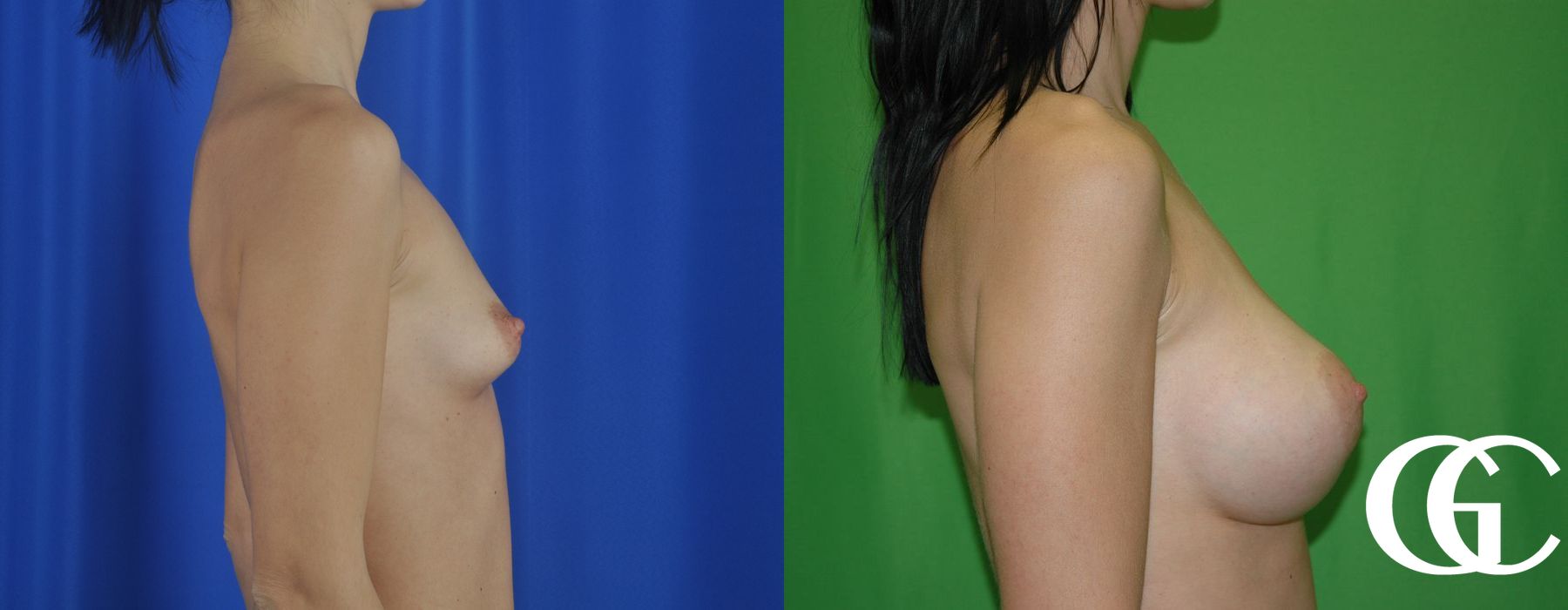 Breast Augmentation - Thumbnail 3