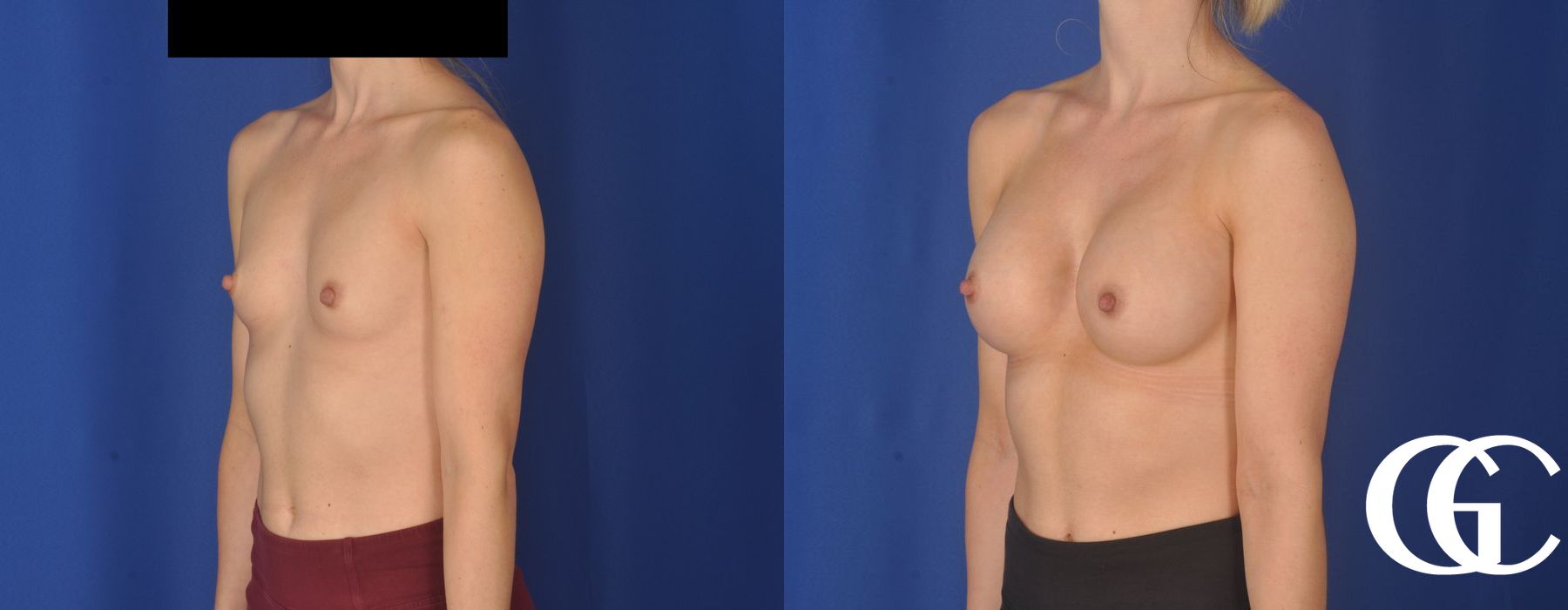 Breast Augmentation - Thumbnail 4