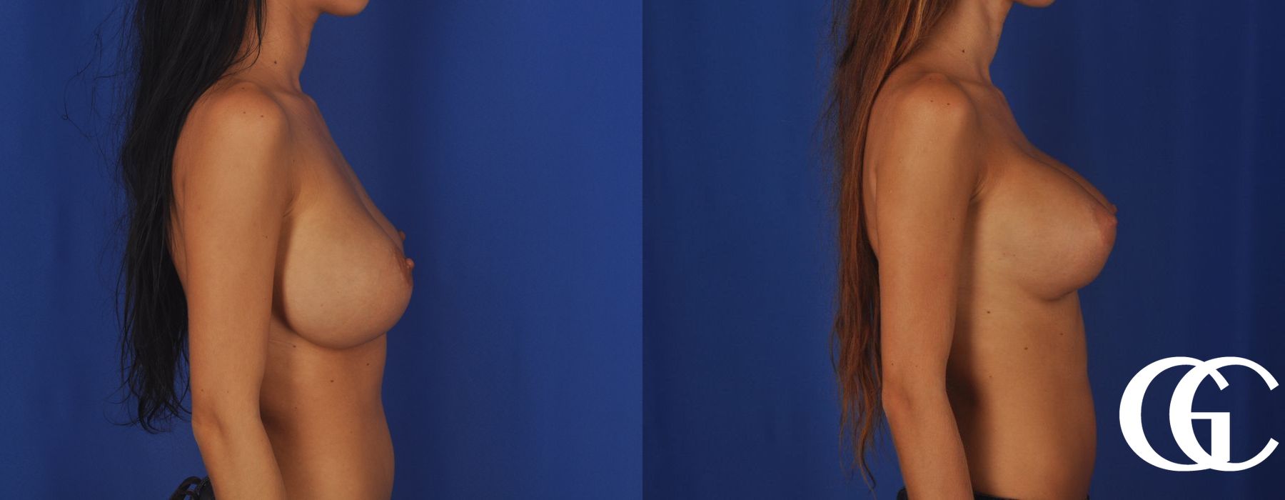 Breast Augmentation - Thumbnail 4