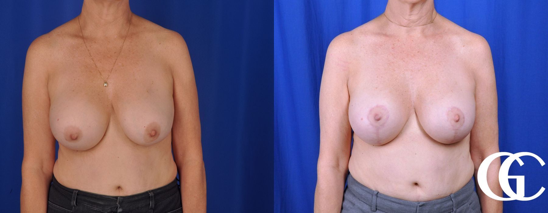 Breast Augmentation - Case 7039
