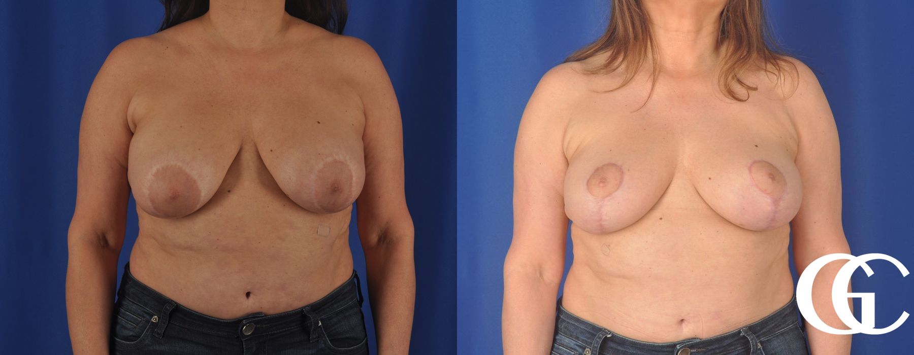 Breast Augmentation - Thumbnail 3