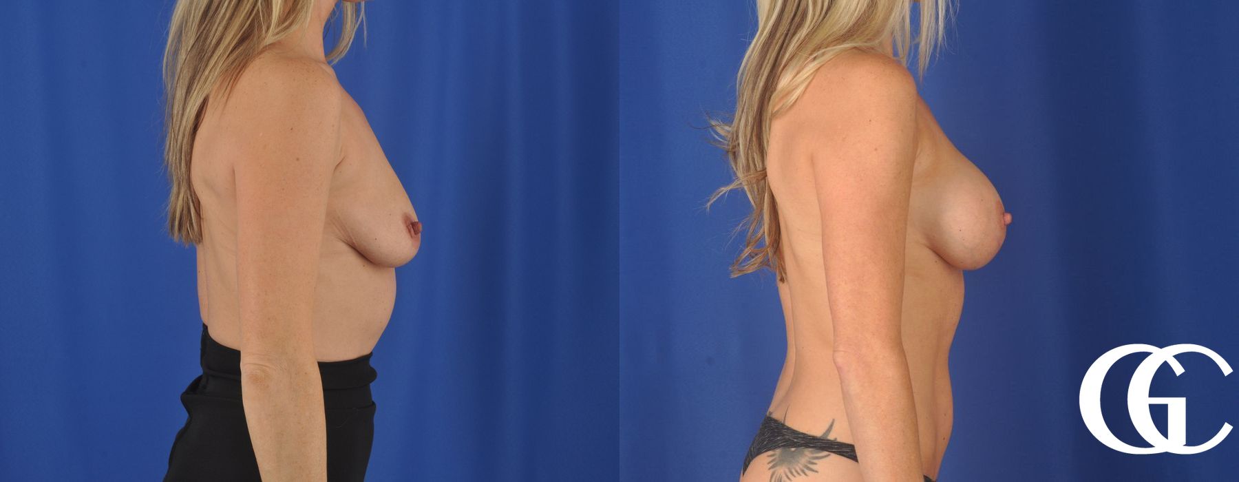 Breast Augmentation - Case 7164