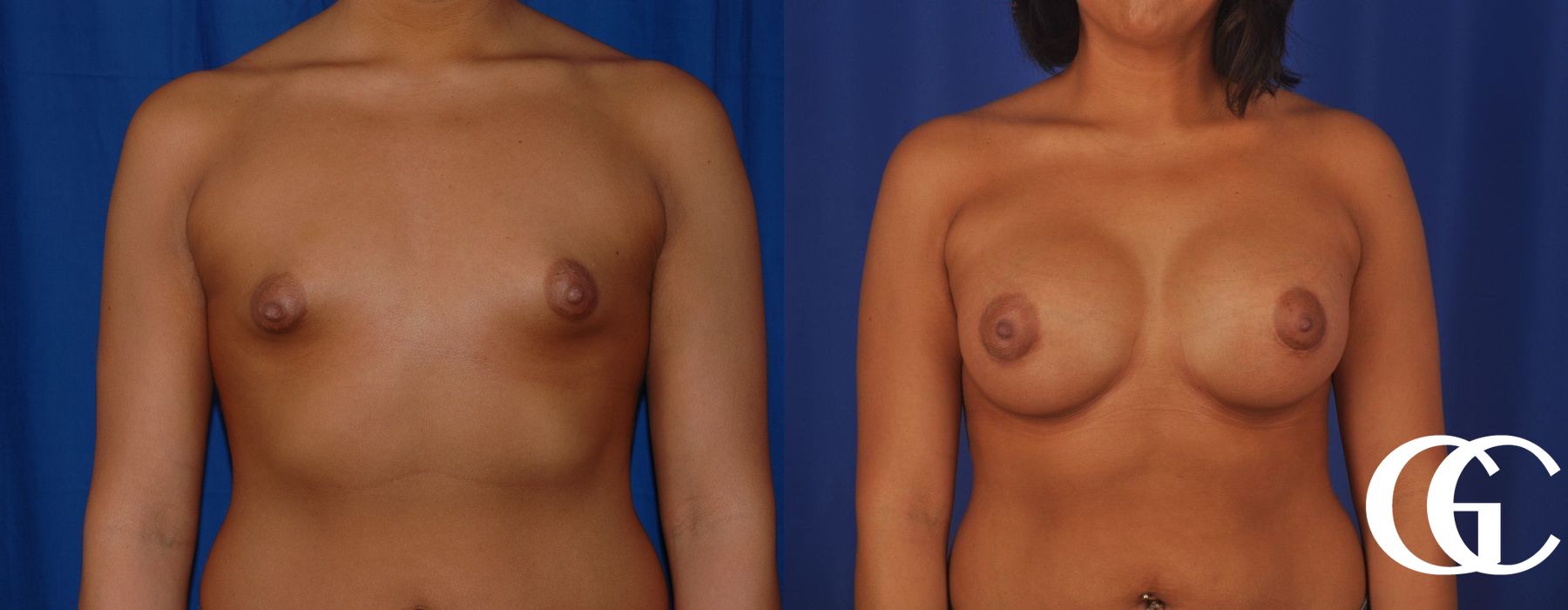 Breast Augmentation - Case 7192