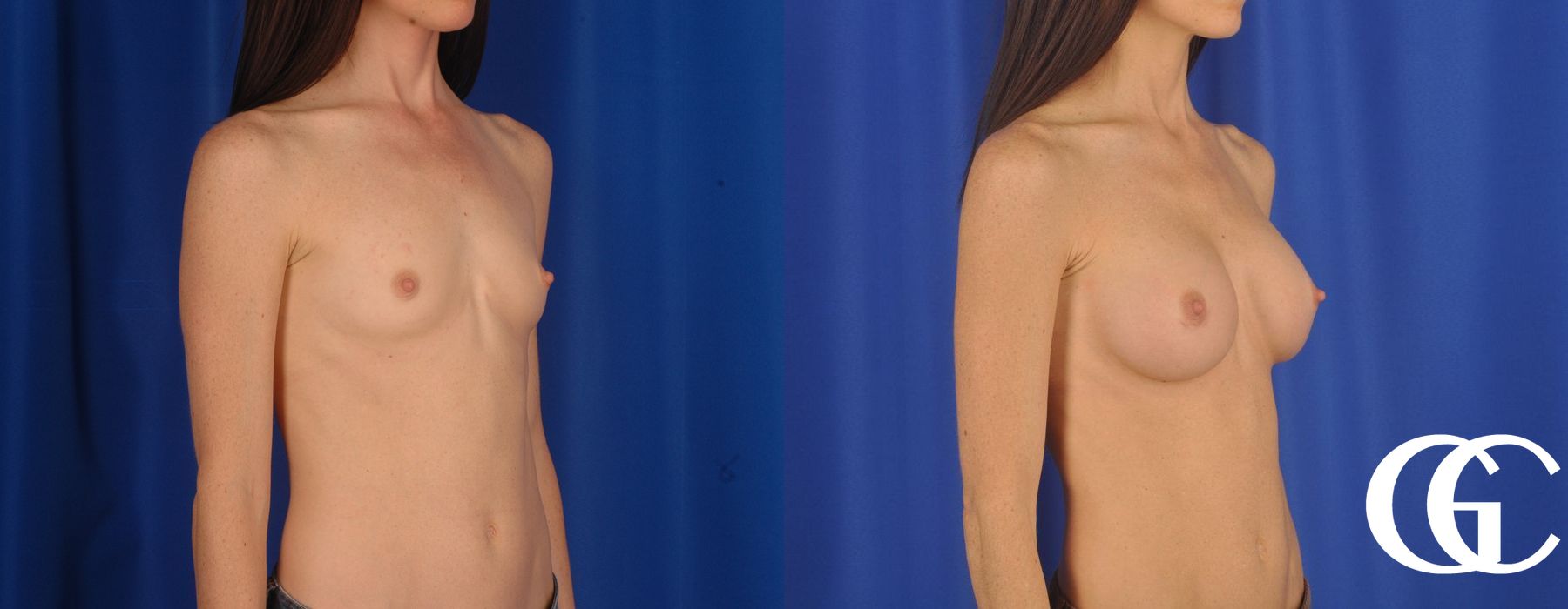 Breast Augmentation - Case 7056
