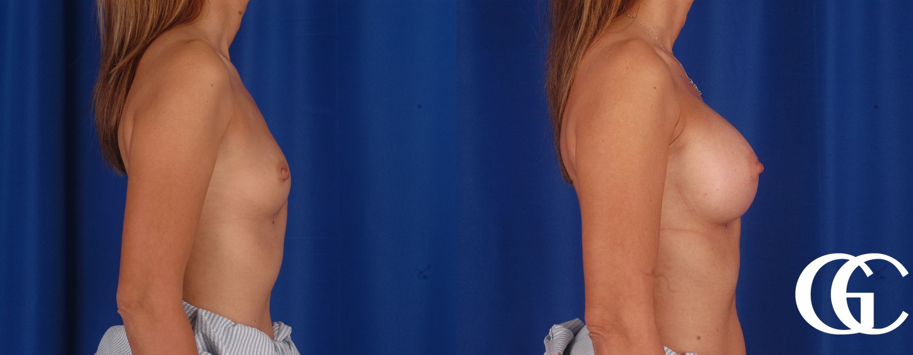 Breast Augmentation - Thumbnail 4