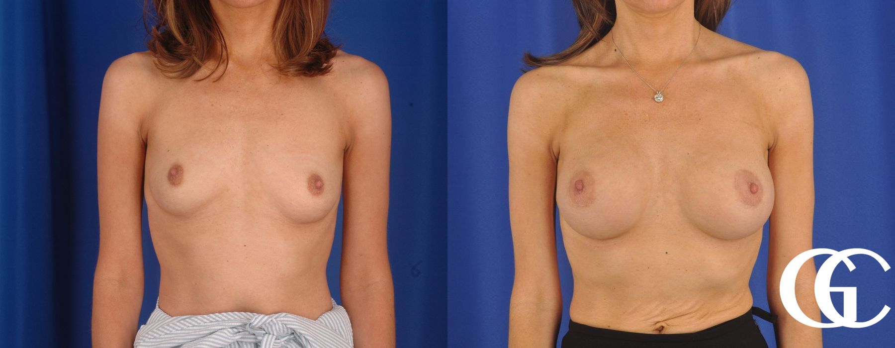 Breast Augmentation - Thumbnail 3