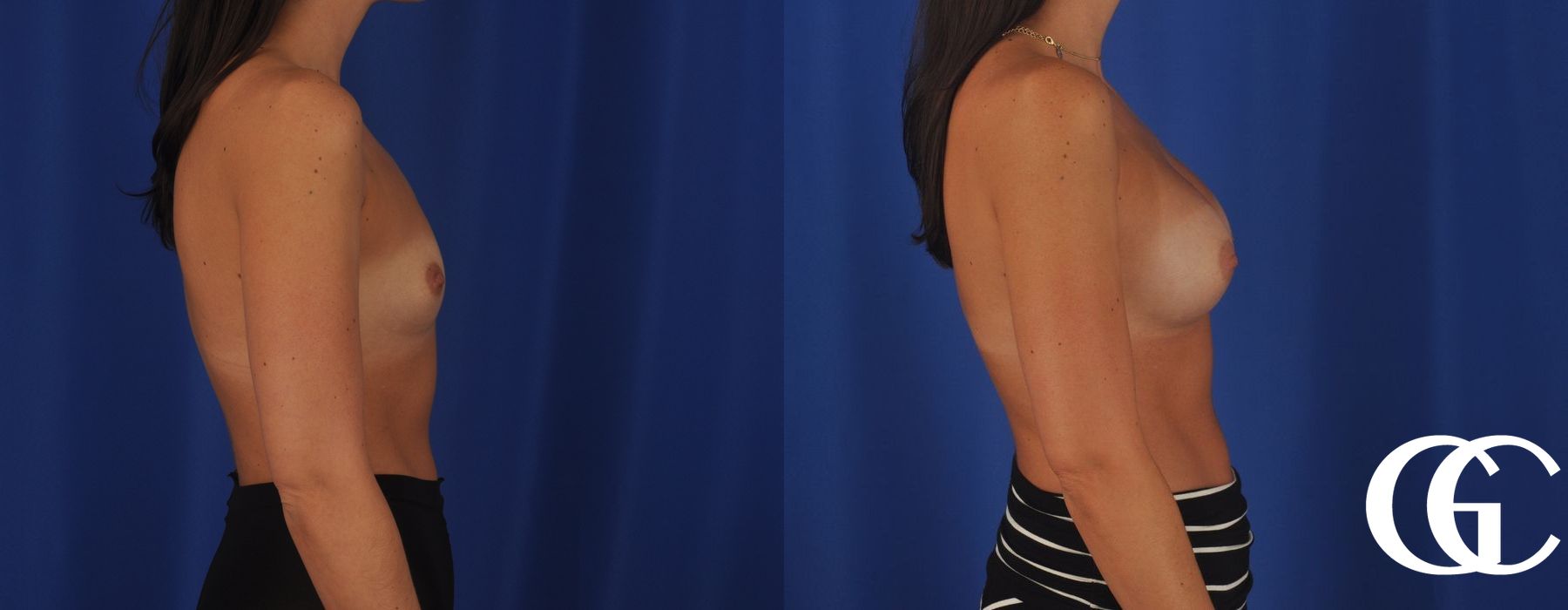 Breast Augmentation - Thumbnail 3