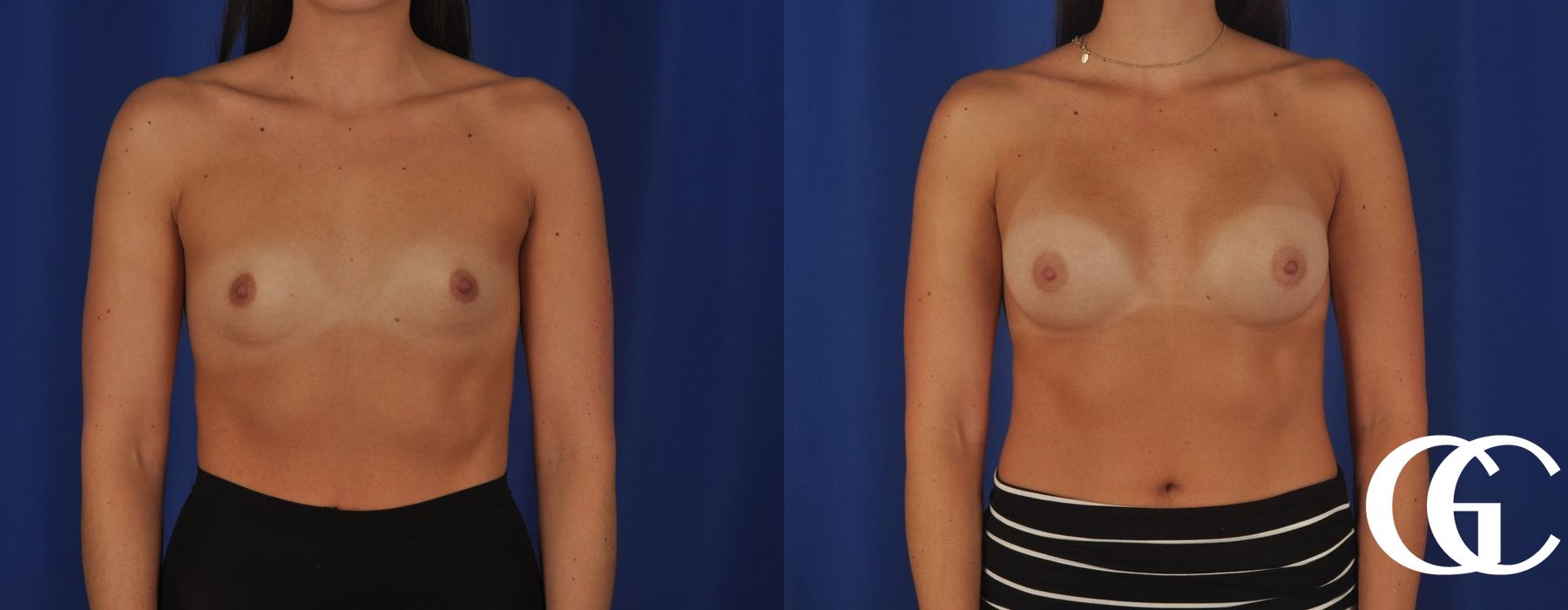 Breast Augmentation - Case 7128