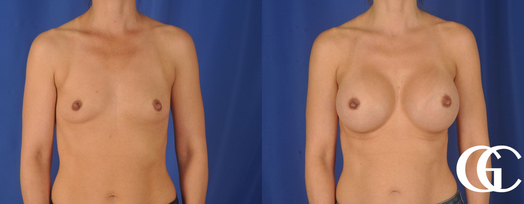 Breast Augmentation - Thumbnail 2
