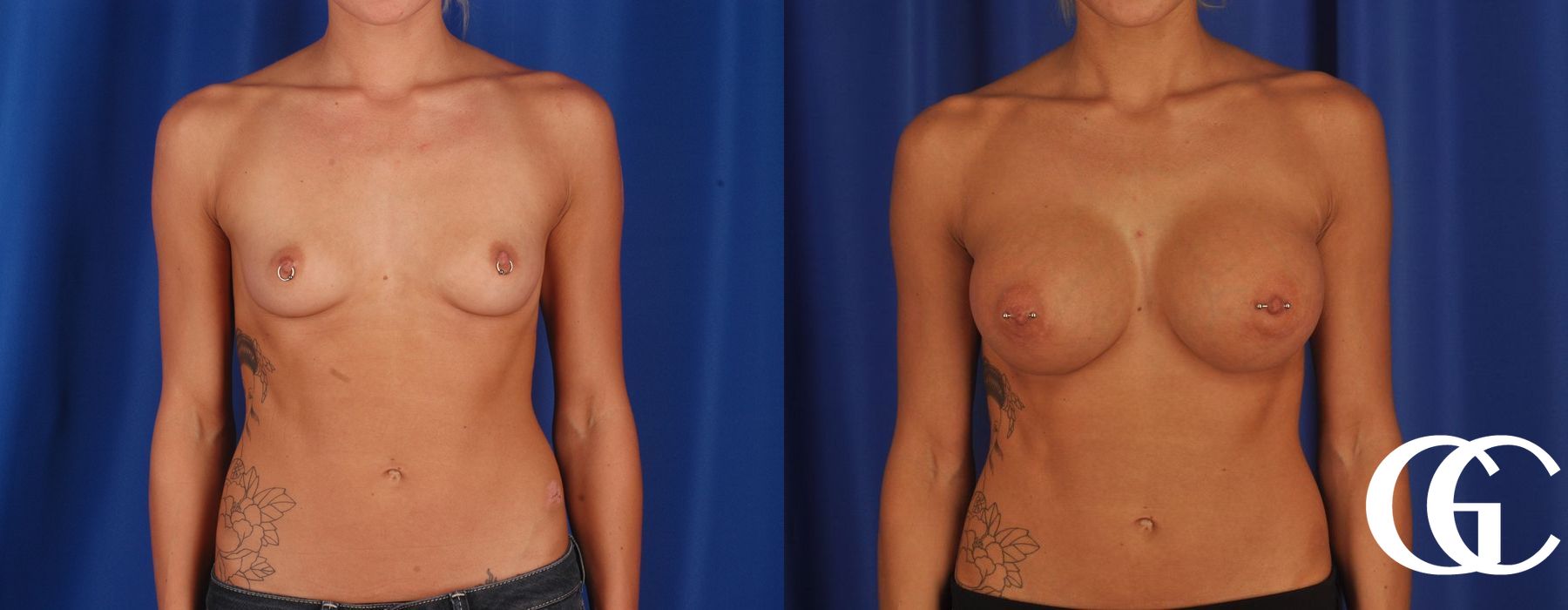 Breast Augmentation - Thumbnail 2