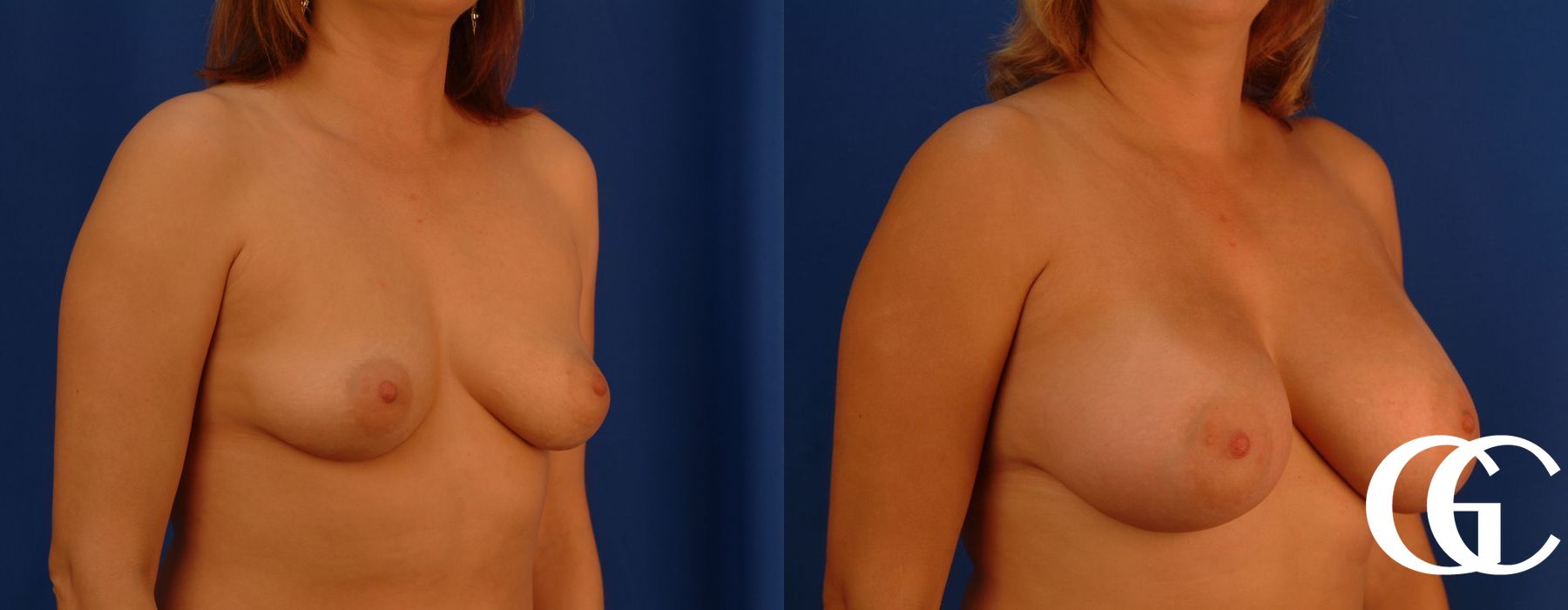 Breast Augmentation - Thumbnail 3