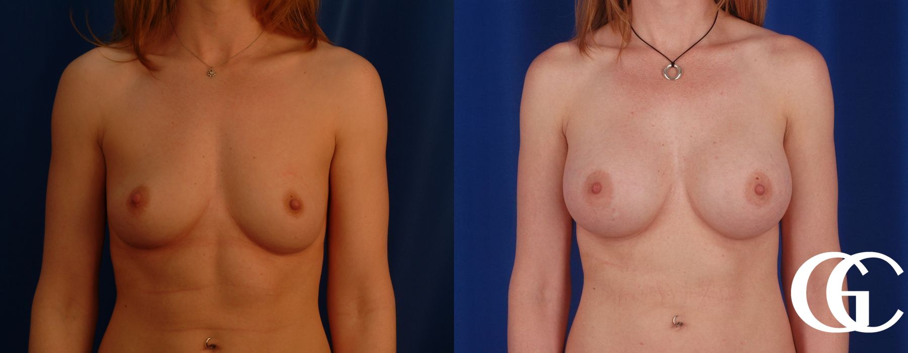 Breast Augmentation - Thumbnail 2