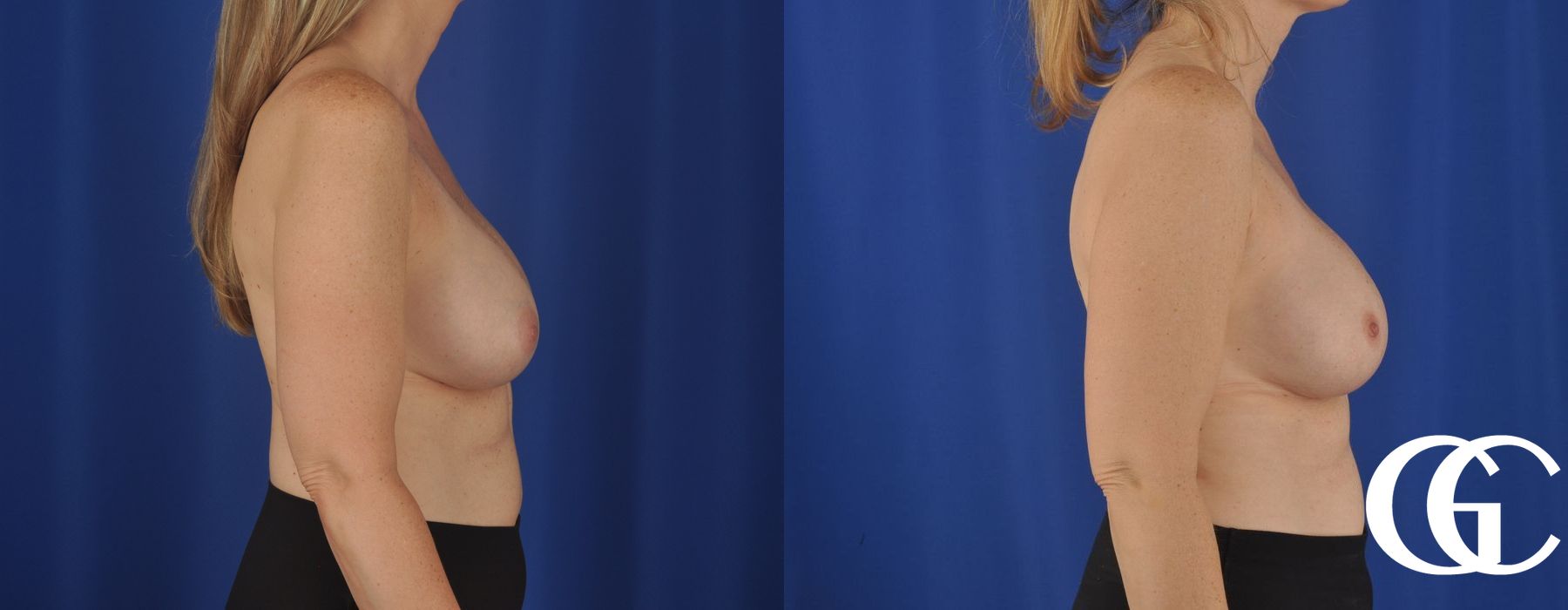 Breast Augmentation - Thumbnail 3