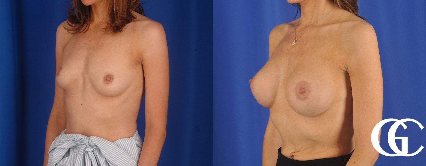 Breast Augmentation - Thumbnail 5