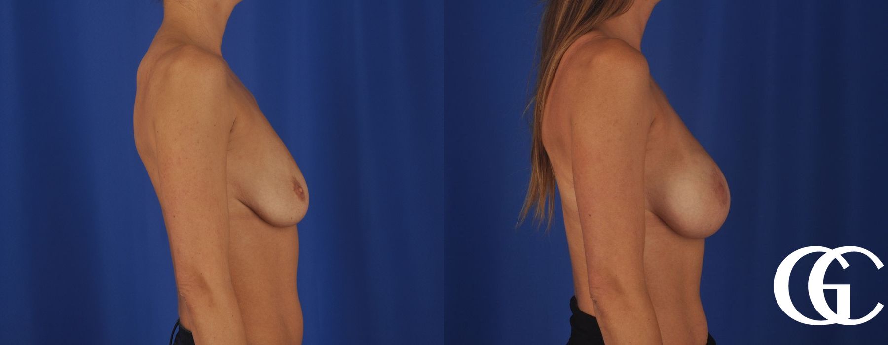 Breast Augmentation - Thumbnail 3