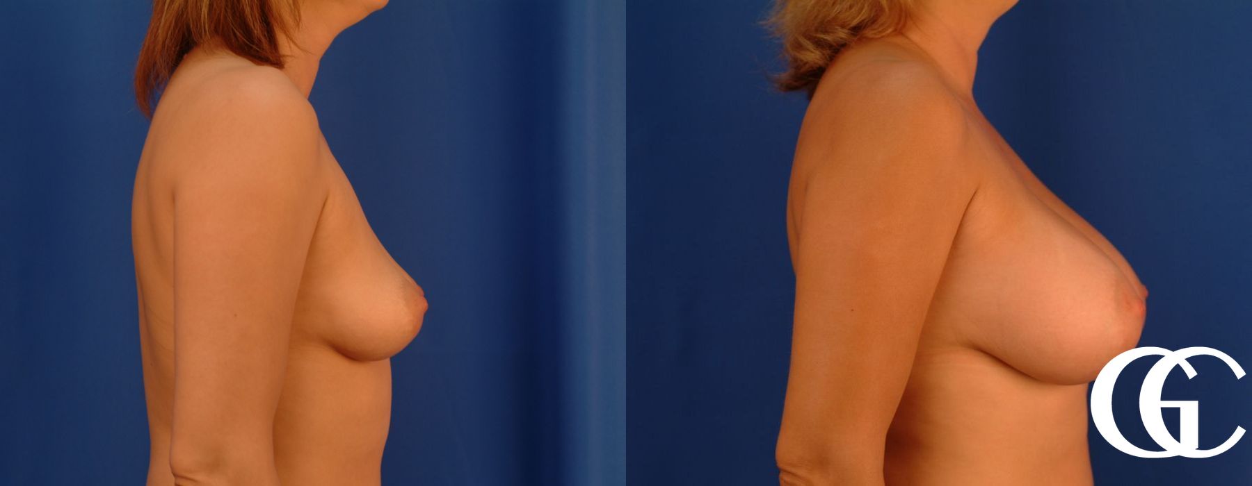 Breast Augmentation - Case 7101