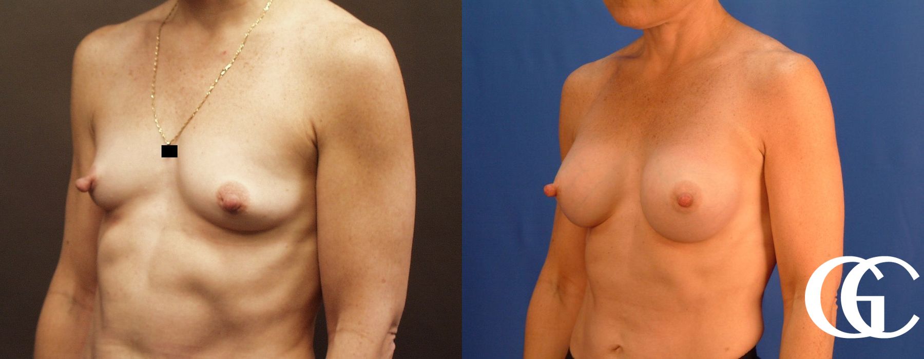 Breast Augmentation - Thumbnail 5