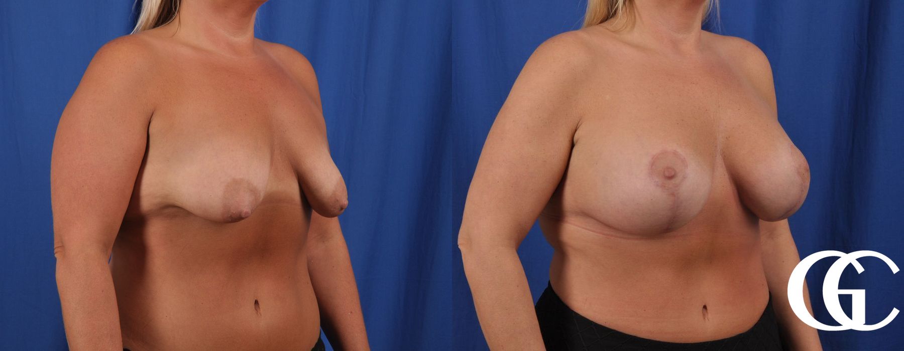 Breast Augmentation - Thumbnail 3