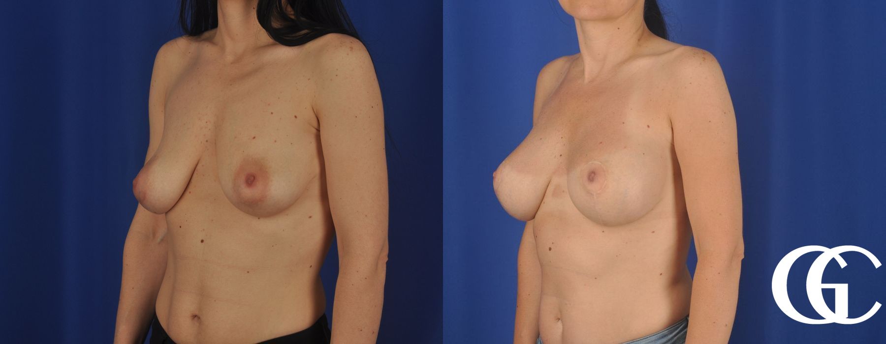 Breast Lift - Thumbnail 4