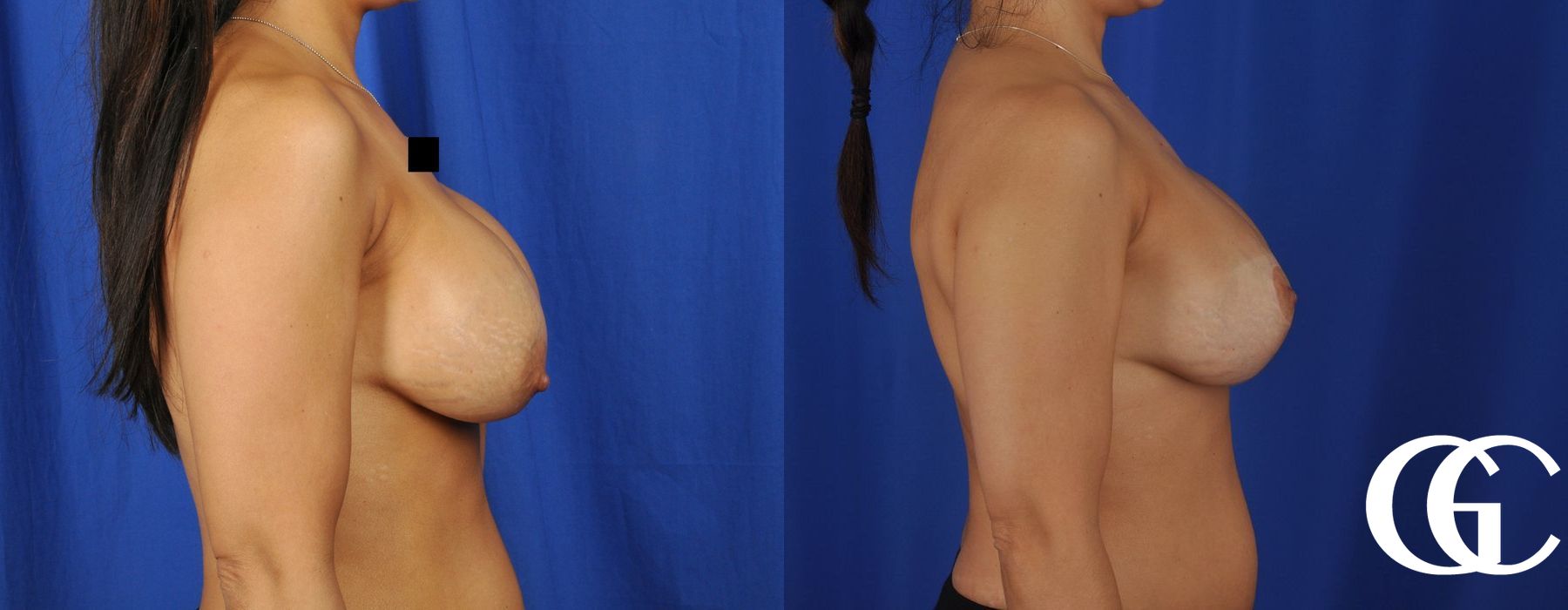 Breast Lift - Thumbnail 3