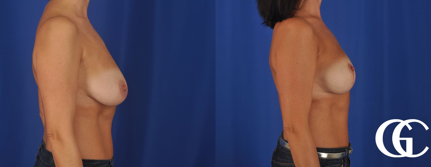 Breast Lift - Thumbnail 4