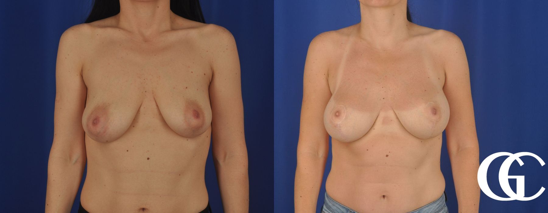 Breast Lift - Thumbnail 2