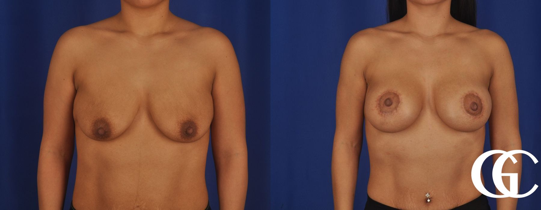 Breast Lift - Case 7295