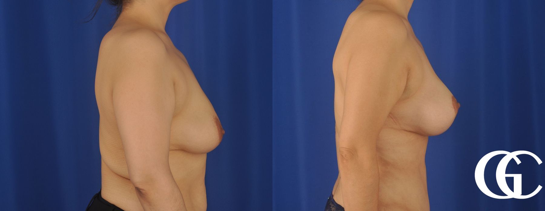 Breast Lift - Thumbnail 3