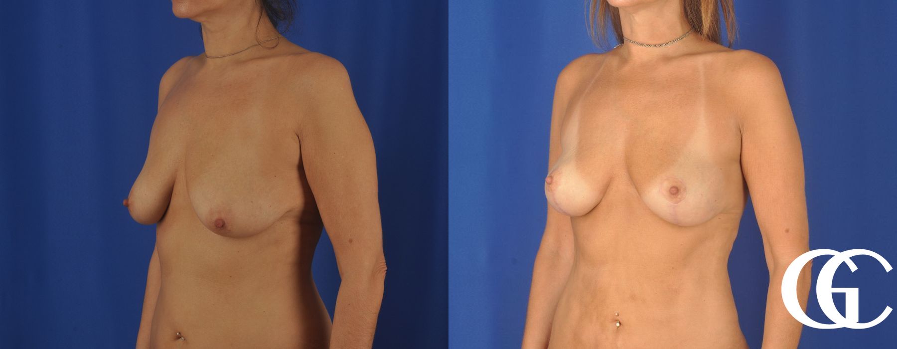 Breast Lift - Thumbnail 3